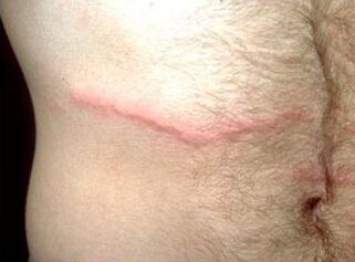 How to eliminate parasites under the skin