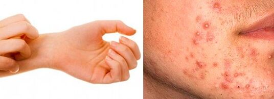 Symptoms of parasites under human skin