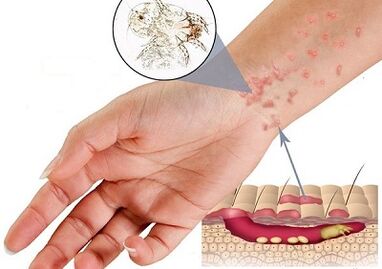 The manifestation of the presence of parasites under the skin