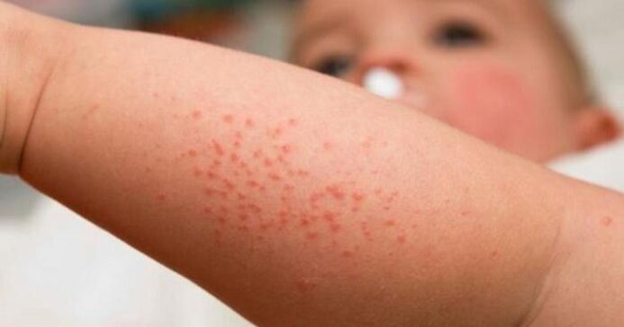 Skin rash is a symptom of a parasitic infection