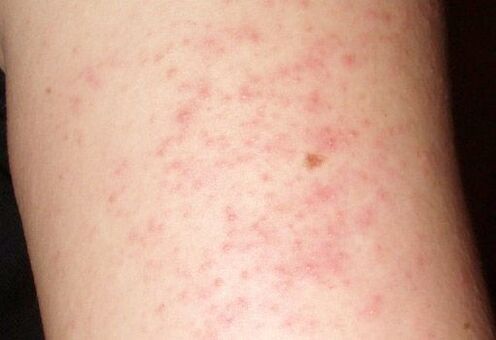An itchy rash on the skin is a symptom of worms in the liver